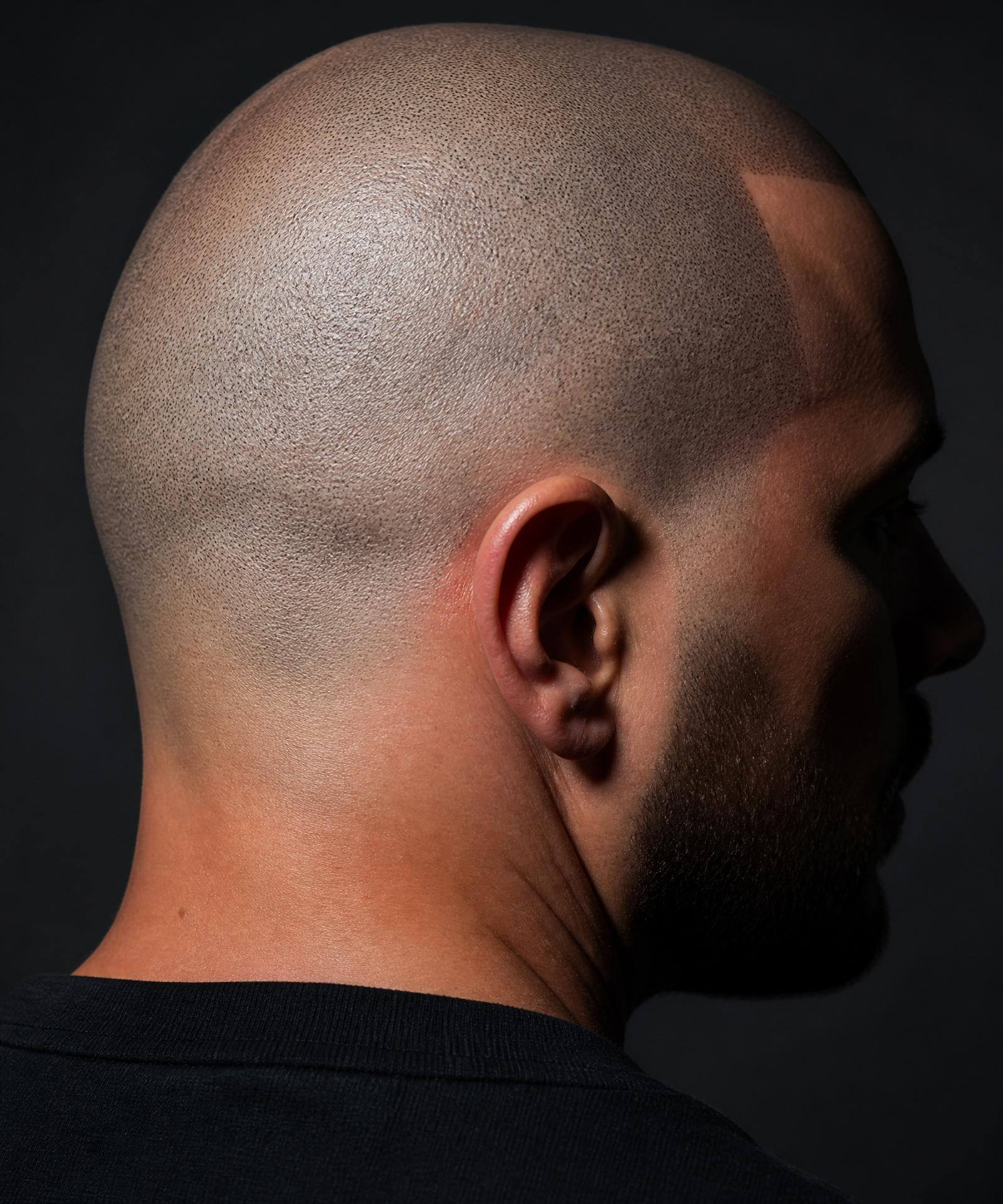 Detailed side profile showing scalp micropigmentation result